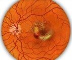 макулодистрофия сетчатки глаза